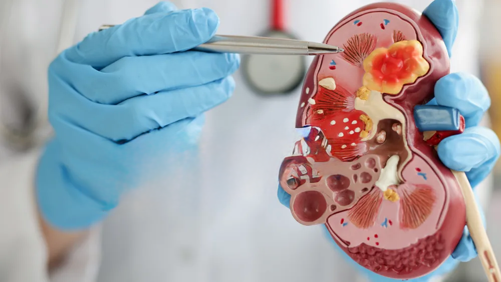 What Causes Kidney Stones?